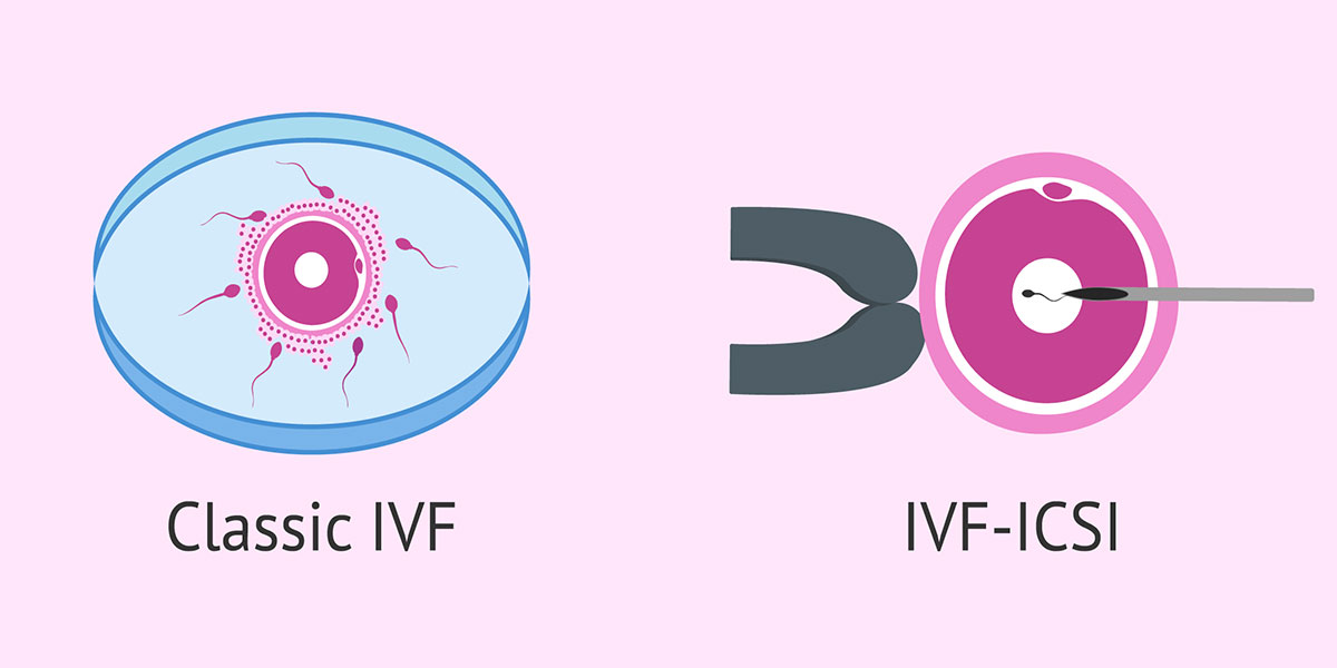 Differences between IVF and ICSI